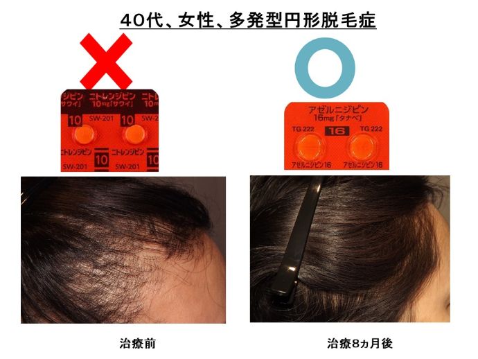 円形脱毛症　病院